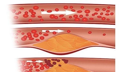 膽固醇高有什么危害？警惕“壞膽固醇”越界,，“糊住”血管(圖1)