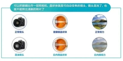 愛爾眼科：白內(nèi)障不會“缺席”只會“遲到”？